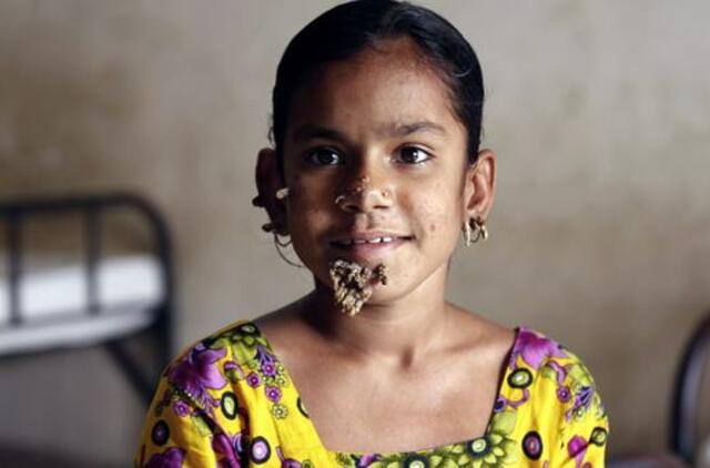 Bangladešo medikai sėkmingai operavo pirmąją pasaulyje "mergaitę medį"