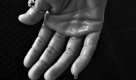 Nemalonus pėdų ir rankų prakaitavimas – signalas įspėjantis apie rimtas ligas